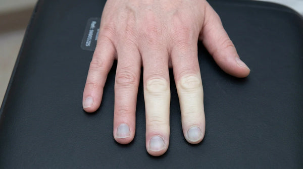 Close up of a hand experiencing a severe raynauds attack with stark white fingers